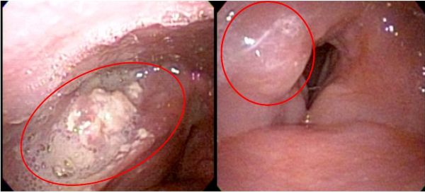 喉嚨痛三個月竟是癌症警訊　義大醫療跨團隊即時診斷下咽癌 整合手術與免疫治療　拓展頭頸癌治療思維1